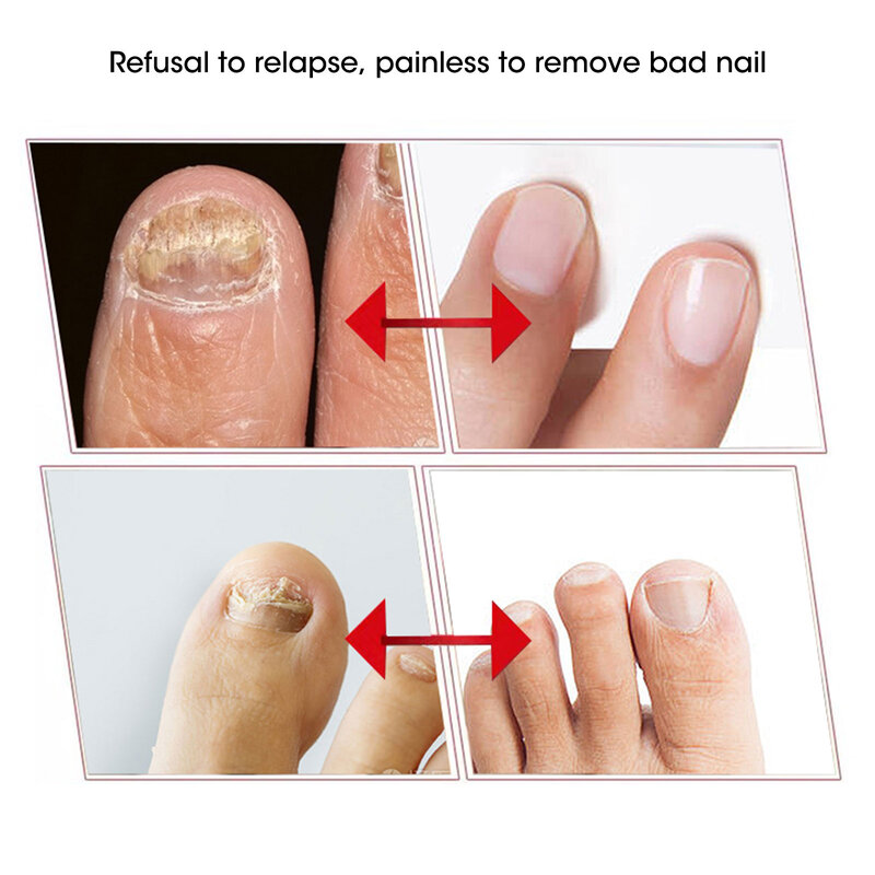 Traitement antifongique des ongles, soins des pieds, Essence, blanchiment des ongles, élimination des champignons des orteils, Gel Anti-Infection, paronychie