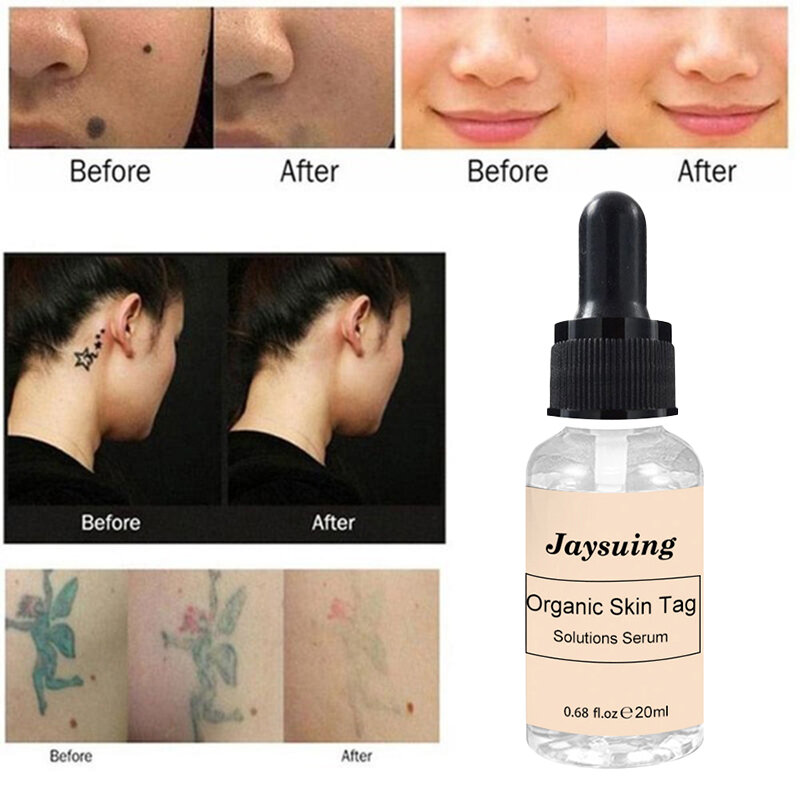 10/20ML soluzioni per etichette organiche siero Skin Tag Remover siero indolore talpa pelle macchia scura rimozione lentiggine crema olio intonaco