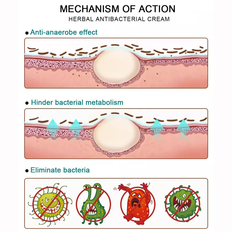 Yoxier 초본 항균 크림 건선 크림 가려움증 완화 습진 피부 발진 Urticaria Desquamation 치료 20G