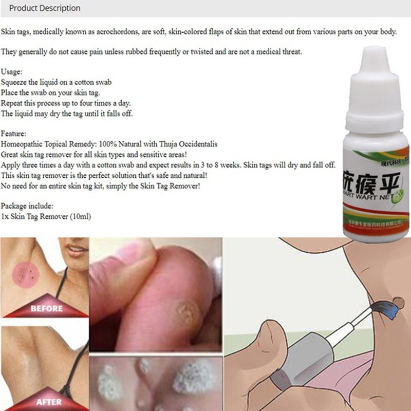 10ml/20ml Skin Tag Remover 12 hours Medical kill Remover Skin Tag Mole & Genital Wart Remover Foot Corn Removal