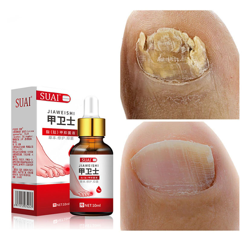 Tratamento de fungos para unhas, essência para cuidados com os pés, clareamento das unhas dos pés, gel removedor de fungos contra infecção, paroníquia, onicomicose