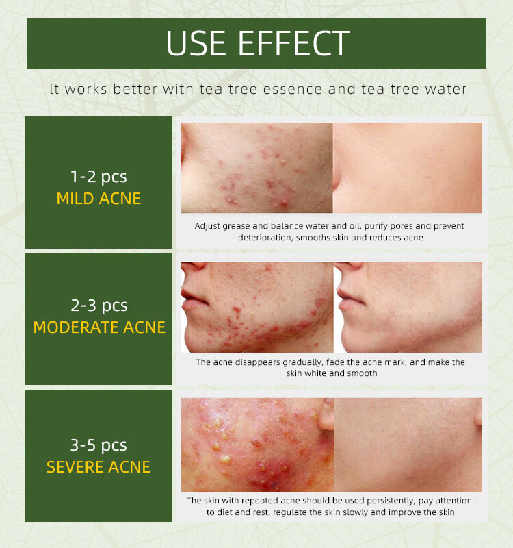 Creme eficaz erval da remoção da acne anti inflamação tratamento da acne acne acne acne acalmar reparação fade manchas de acne controle de óleo cuidados com a pele