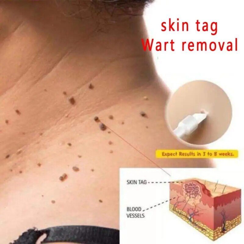 10ml Skin Tag Remover etichette per la pelle rimozione verruca genitale cura dei piedi crema trattamento piede rimozione del mais rimozione di punti neri liquido TSLM1