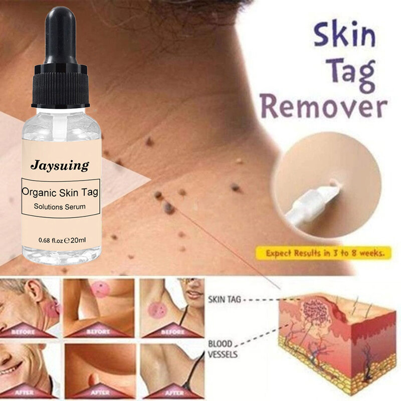 10/20ML Organic Tags Solutions Serum Skin Tag Remover Serum Painless Mole Skin Dark Spot Freckle Remover Cream Oil Plaster