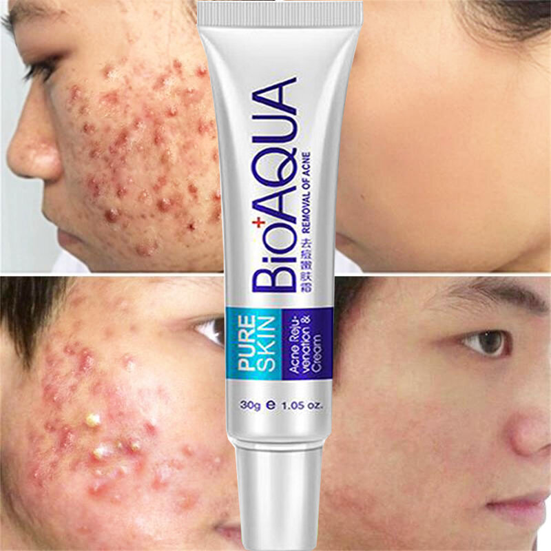 BIOAQUA Acne Scar Removal Cream Gel Anti-Acne Treatment Face Whitening Cream Oil Control Fade Dark Spot Pore Minimizer Skin Care