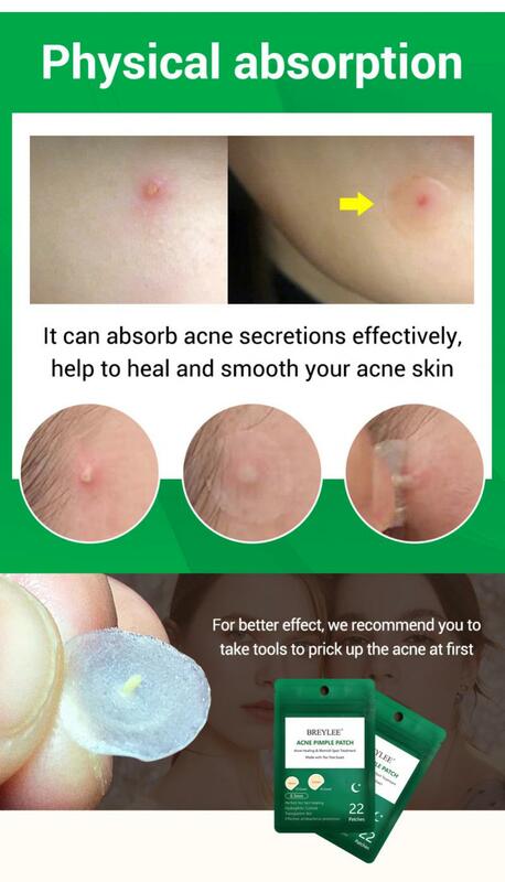 BREYLEE Acne Pimple Patch Stickers Acne Treatment Pimple Remover Tool Blemish Spot Facial Mask Skin Care Waterproof 22 Patches