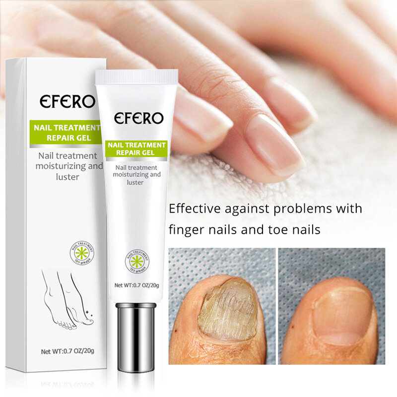 15ミリリットル感染美容爪真菌治療健康インスタントが爪真菌感染治療クリーム爪修理ゲル用品