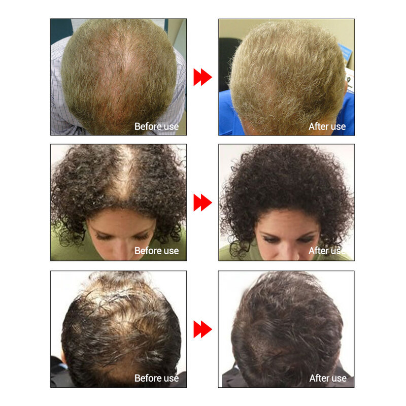 LANBENA crescita dei capelli olio essenziale prevenire efficacemente la perdita dei capelli siero cuoio capelluto trattamento calvizie prodotto per la crescita dei capelli per donna uomo