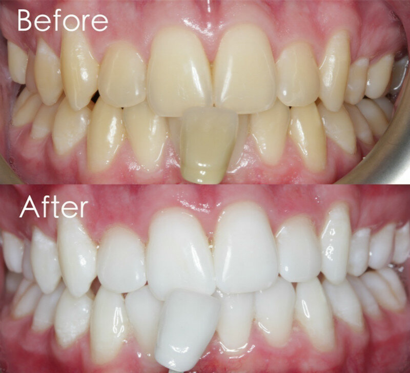 Extrato de ervas orgânicas para clareamento dental, clareamento dental, higiene oral saudável, limpeza da boca, limpar a placa removedora de manchas