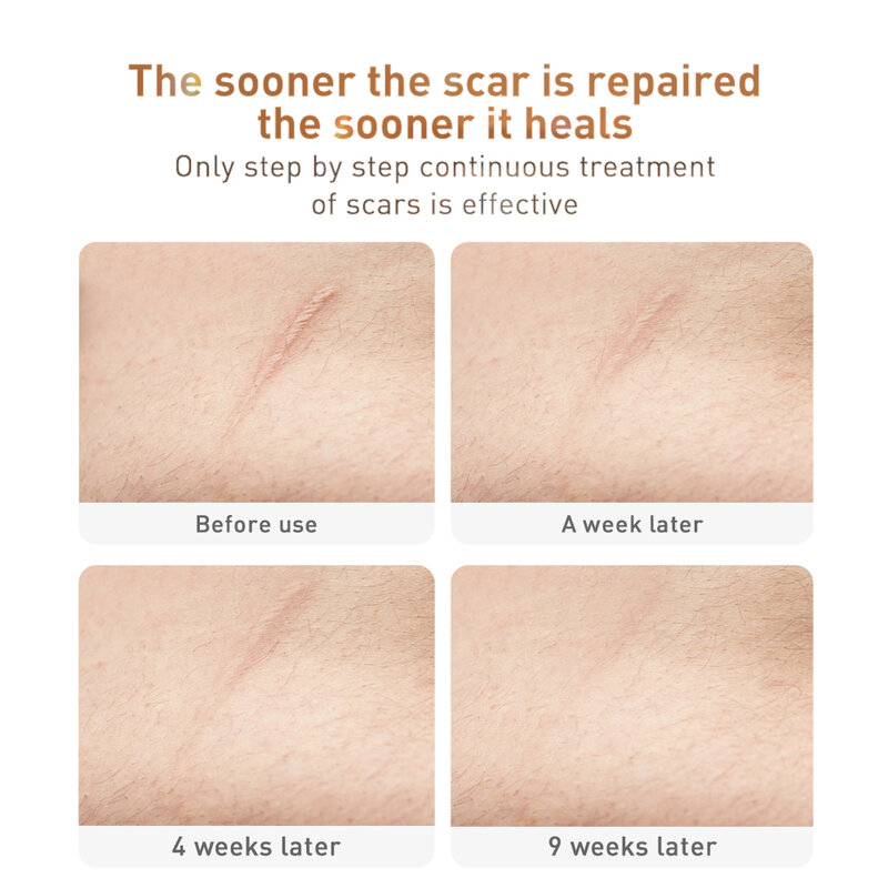 5Pcs LANBENA Scar Gel TCM ยากำจัดแผลเป็นครีมสิว Stretch Marks Remover Keloid Skin Repair Face Spots Treatment Care