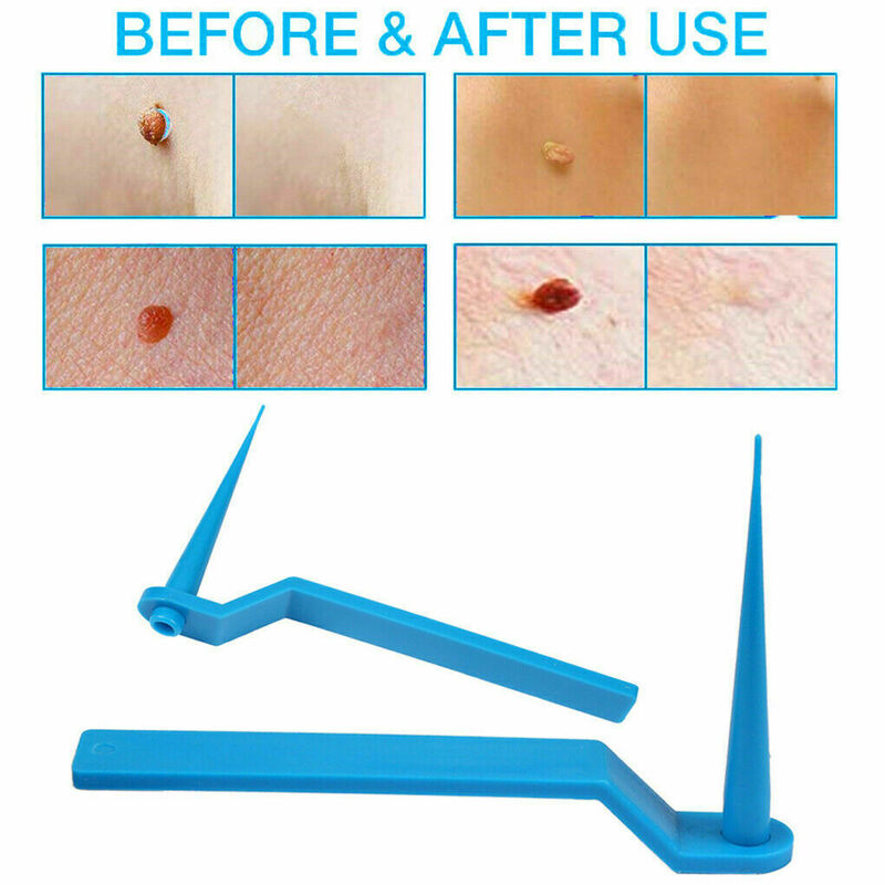 Kit de remoção de toupeira para remover verrugas e toupeira ferramenta de remoção de etiquetas de pele pequena a média