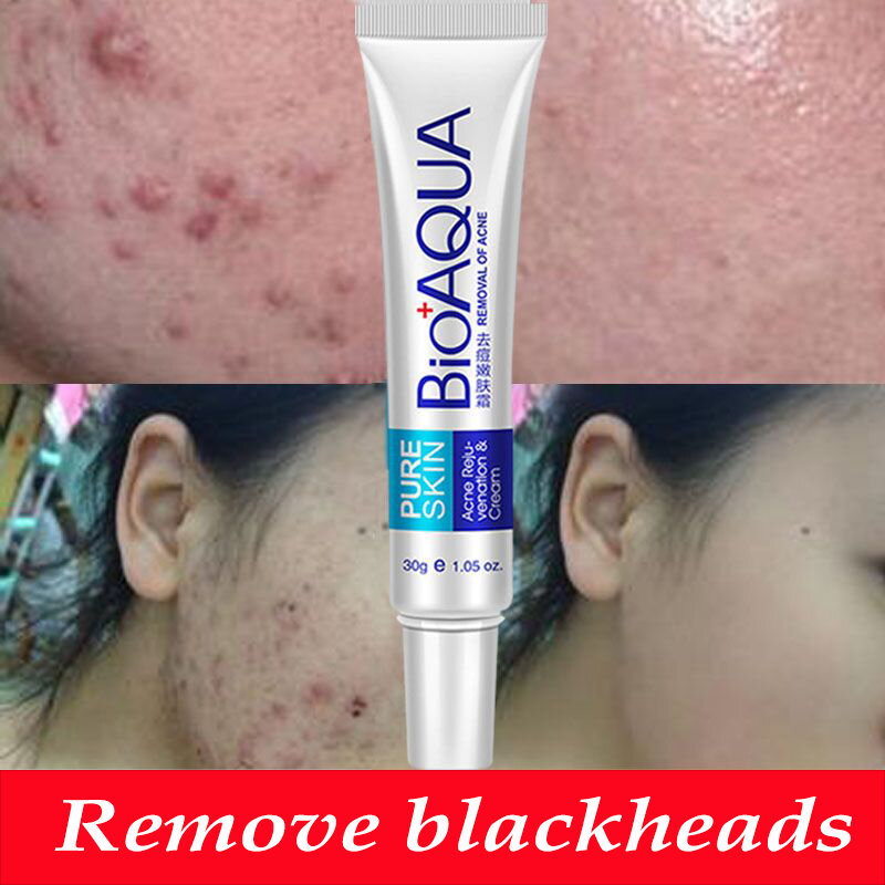 Bioaqua 30g tratamento da acne cravo remova anti acne creme controle de óleo encolher poros acne cicatriz remover cuidados com o rosto clareamento