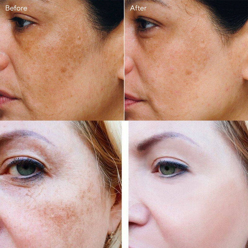 Freckle Cream Remove Dark Spots Whitening Cream Fade Acne Scars Brighten Melanin Pigmentation Melasma Anti-Aging Whiten Skin 20g