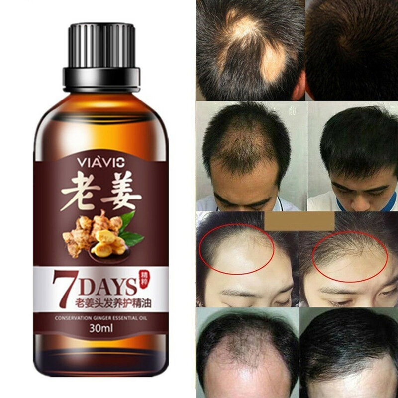ขิง Hair Growth Oil Hair Care Healthy Nourishing Anti Hair Loss Fast หนาแน่น Regrowth ขิงเซรั่ม30ML