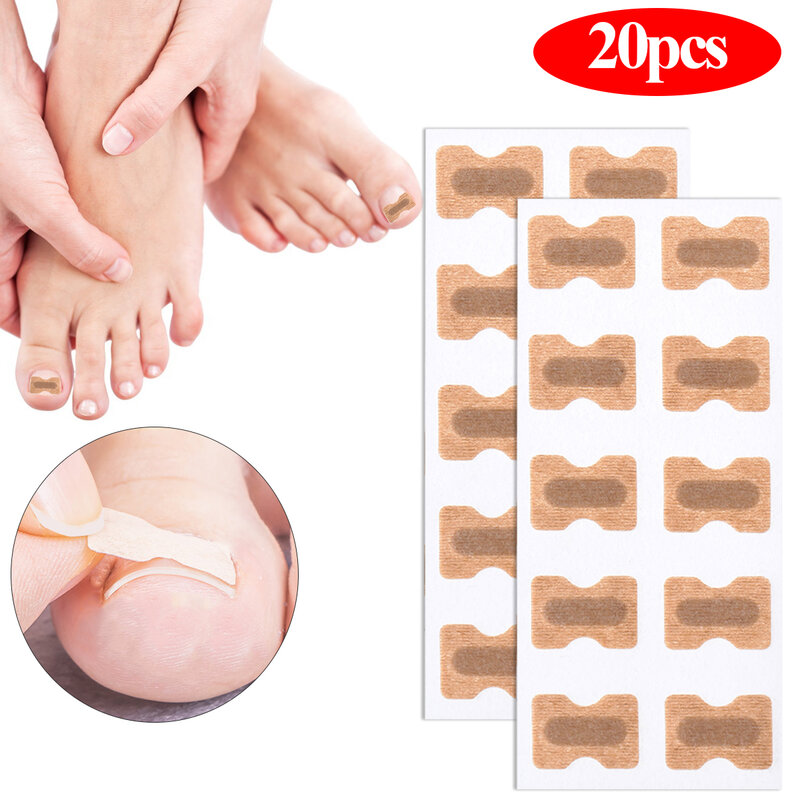 20/50/100 pces correção do prego adesivos encravados toenail corrector remendos paronychia tratamento recuperar corretor pedicure ferramentas