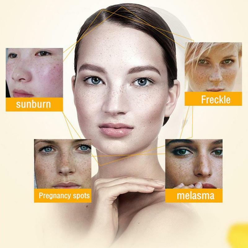 Clareamento de manchas escuras creme para o rosto remover melasma acne cicatriz pigmento melanina pele escura pigmentação corrector hidratante cuidados com a pele