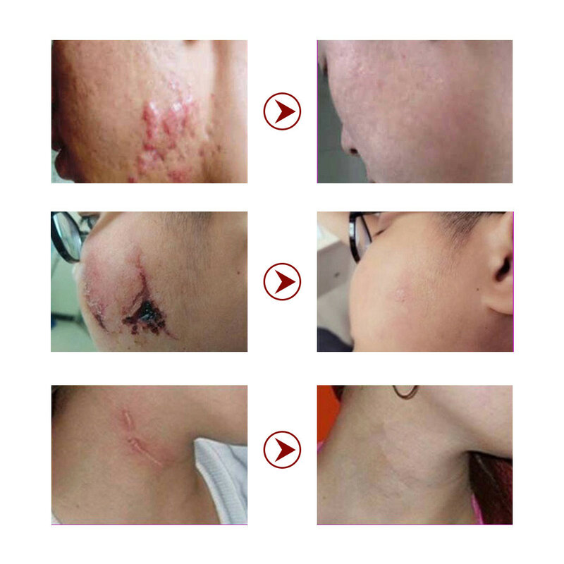 Smoothing Skin Scar Cream Postpartum Surgery Scald Ointment Burn Acne Scars Repair Whitening Lightening Brighten Face Body Care