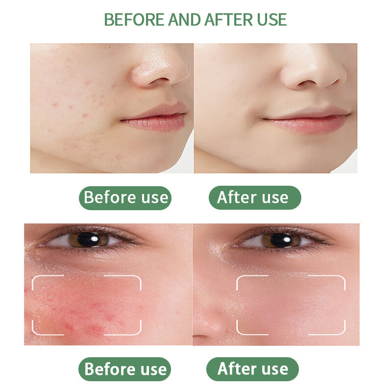 Youngcome 10g reparação sarda rugas chloasma idade manchas clareamento hidratante restaurar a saúde da pele acne creme