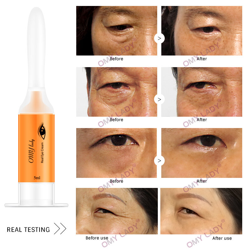 OMY LADY 5 قطعة EyeCream إزالة فورية العين ثبات مكافحة الانتفاخ الهالات السوداء تحت العين المضادة للتجاعيد مكافحة الشيخوخة العناية بالعين