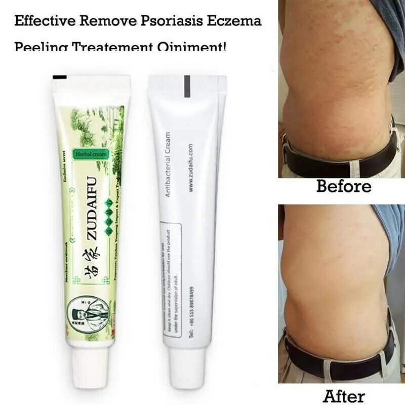 20pc Zudaifu Skin Psoriasis Cream Dermatitis Eczematoid Eczema Ointment From Psoriasis Treatment Skin Care Herbal Cream With Box