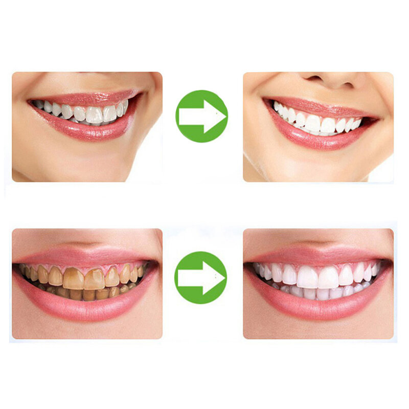 Silikon Nacht Mundschutz für Zähne Pressen Schleifen Dental Beißen Schlaf Hilfe Bleaching Zähne Mund Tablett