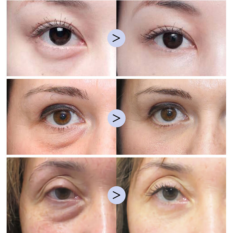 BREYLEE ácido hialurónico suero ojo mejorar ojo bolsa ojo Anti hinchazón de masaje crema de ojos eliminar las arrugas de los ojos crema hidratante