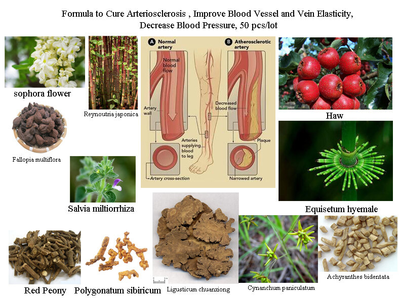 Fórmula de ingredientes herbales naturales para curar la arterioserosis, aumentar la elasticidad de la arteria, limpiar los vasos sanguínea y las venas