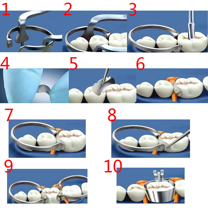 100 pz/scatola sistema di matrice sezionale dentale dentale matrice sezionale banda di serraggio in resina/anello separato dentista strumenti cura orale