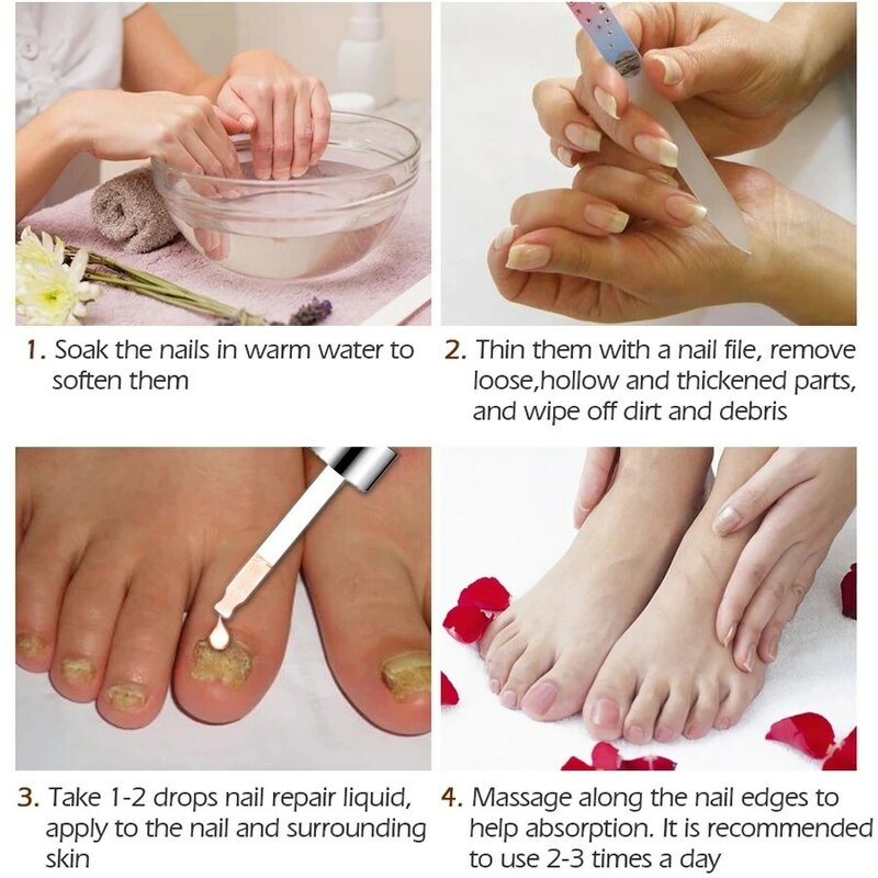 Sérum para el cuidado de los pies, Gel antiinfección para la eliminación de hongos en las uñas, paroniquia y onicomicosis, 8 piezas