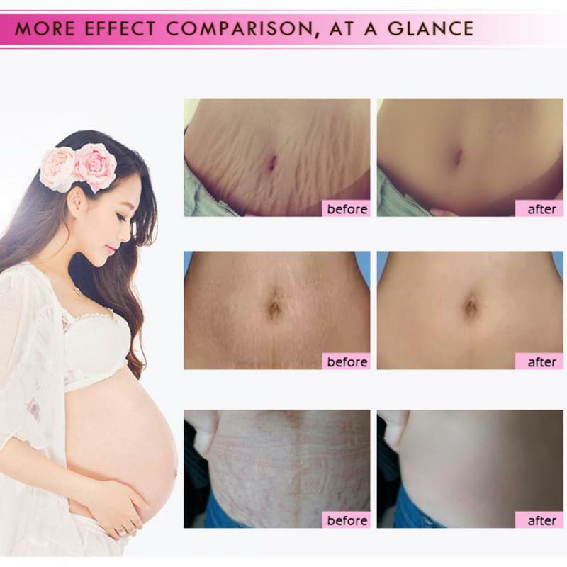 New Concealer Mango Remove Pregnancy Acne Scar Stretch Mark Cream Treatment Maternal Anti-Aging Repair Anti-Wrinkle Firming Body