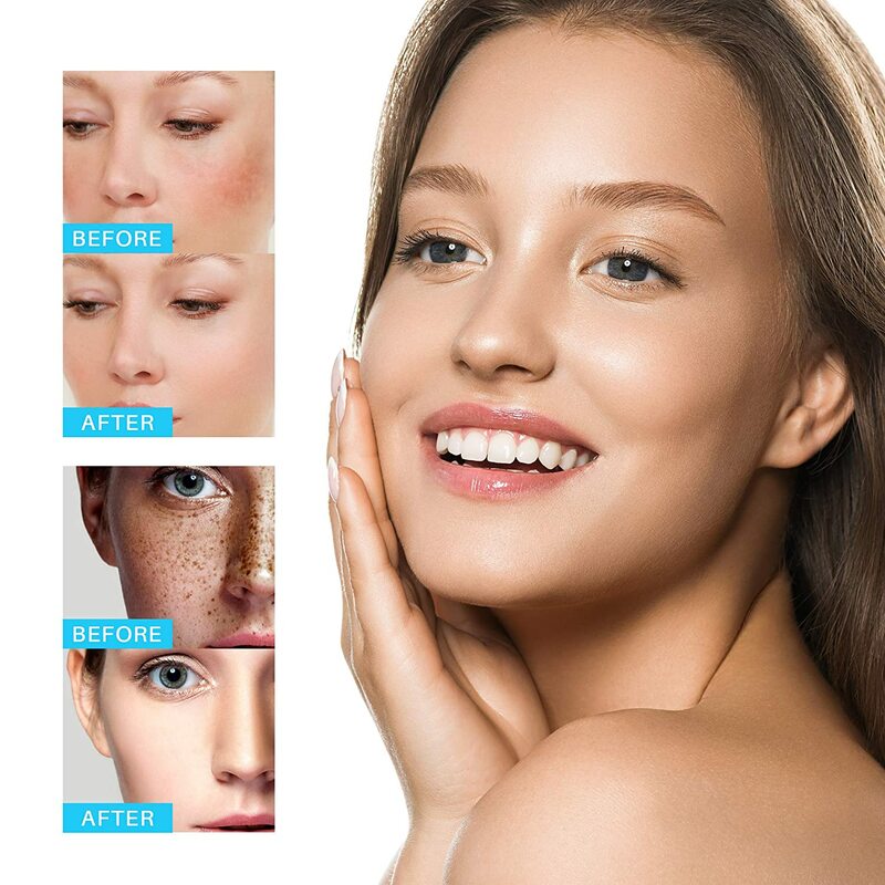 Clareamento de creme de sarda rosto hidratante remover manchas escuras melanina melasma removedor clareamento da pele reparação eficaz anti-envelhecimento