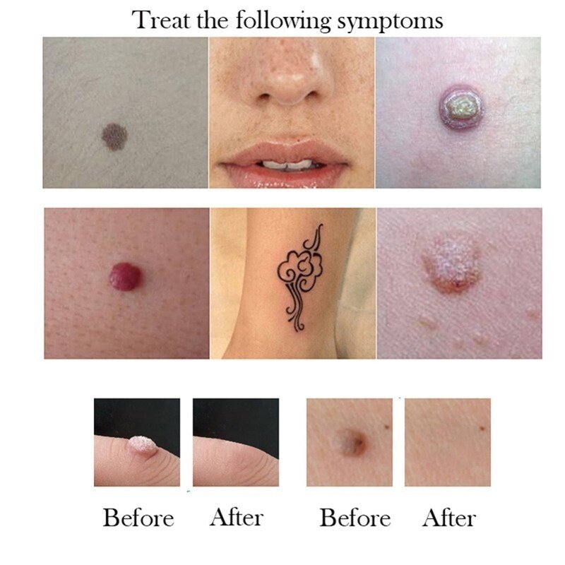 Mole & Skin Tag Removal Solution Painless Mole Skin Dark Spot Removal Face Wart Tag Freckle Removal Cream Oil Plaster