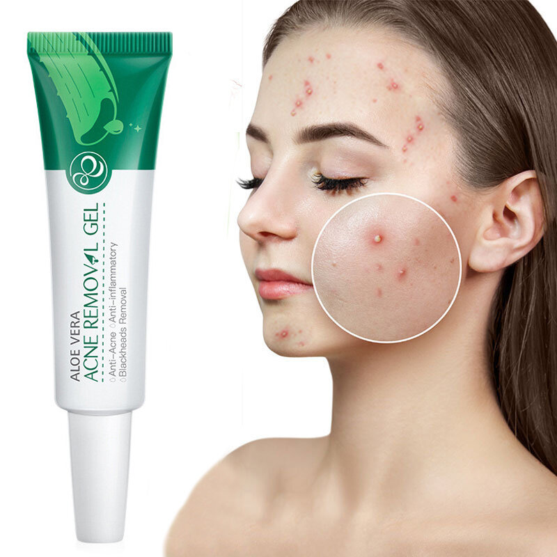 Gel per il trattamento dell'acne all'aloe crema per il viso siero crema Anti-Acne cicatrice pori termoretraibili idratante controllo dell'olio essenza lenitiva cura della pelle