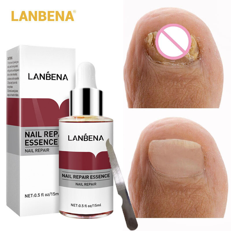 Сыворотка LANBENA грибок ногтей, восстанавливающая эссенция для ногтей на пальцах ног, уход восстановление онихомикоз, смягчение, осветление р...