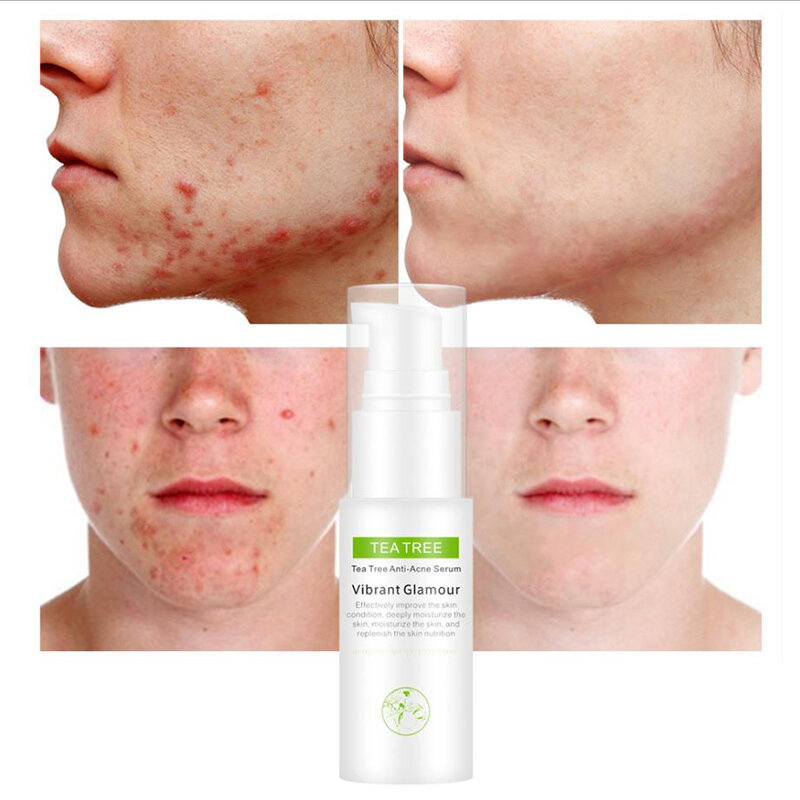 Effective whitening cream, can remove acne essence, treat bleaching, acne spots, control sebum,