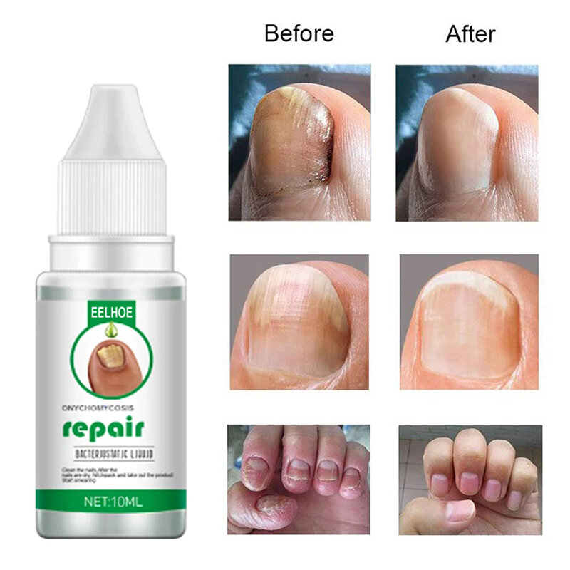 Traitement antifongique pour les ongles, Gel Anti-Infection, soins des pieds, 20ML