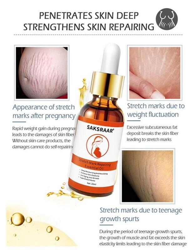 Striae Remover Etherische Olie Behandeling Cream Voor Stretch Mark Verwijderen Moederschap Slappe Lijn Voor Zwangere Lichaam Huidverzorging