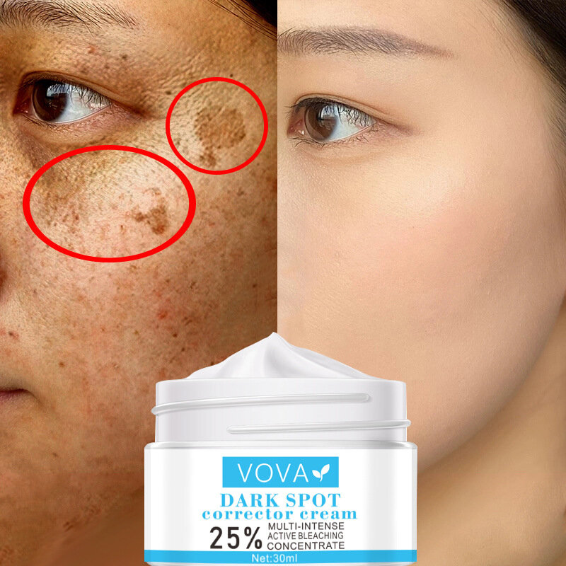 Blanqueamiento oscuro lugar cara crema elimina el Melasma cicatriz de acné pigmento melanina oscura la pigmentación de la piel Corrector hidratante cuidado de la piel