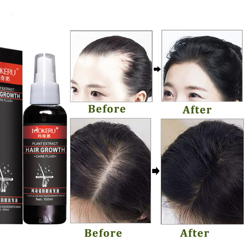 Mokeru-aceite de ricino Natural para hombres, aceite de crecimiento rápido del cabello, tratamiento para la calvicie, 100ml