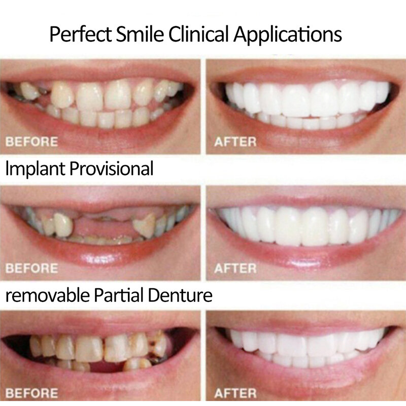 HNKMP superiore e inferiore falso falso sorriso perfetto impiallacciature Comfort Flex dentale protesi dentaria denti sbiancamento bretelle strumento