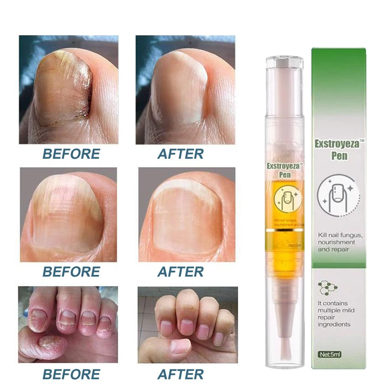 Onycromicosis-Esencia de Dedo del pie de manos, tratamiento para el cuidado de la piel, infección de uñas por hongos, líquido Antibacterial Natural para reparación de hierbas, 5ml