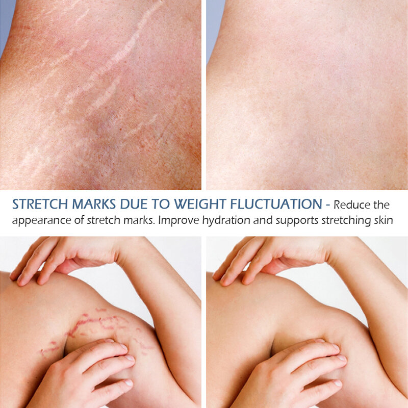 Stretch Marks Remover Essential Oil Skin Care ครีมสำหรับ Stretch Mark Removal คลอดบุตร Slackline สำหรับตั้งครรภ์น้ำมัน