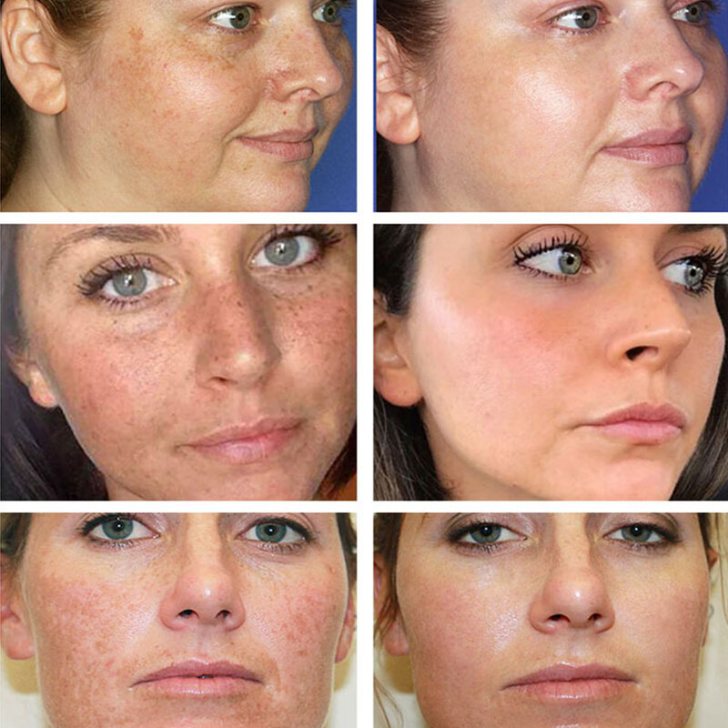 Crema Facial de ácido hialurónico, suero antienvejecimiento, reduce los poros, elimina las arrugas, crema de día hidratante para blanquear la piel