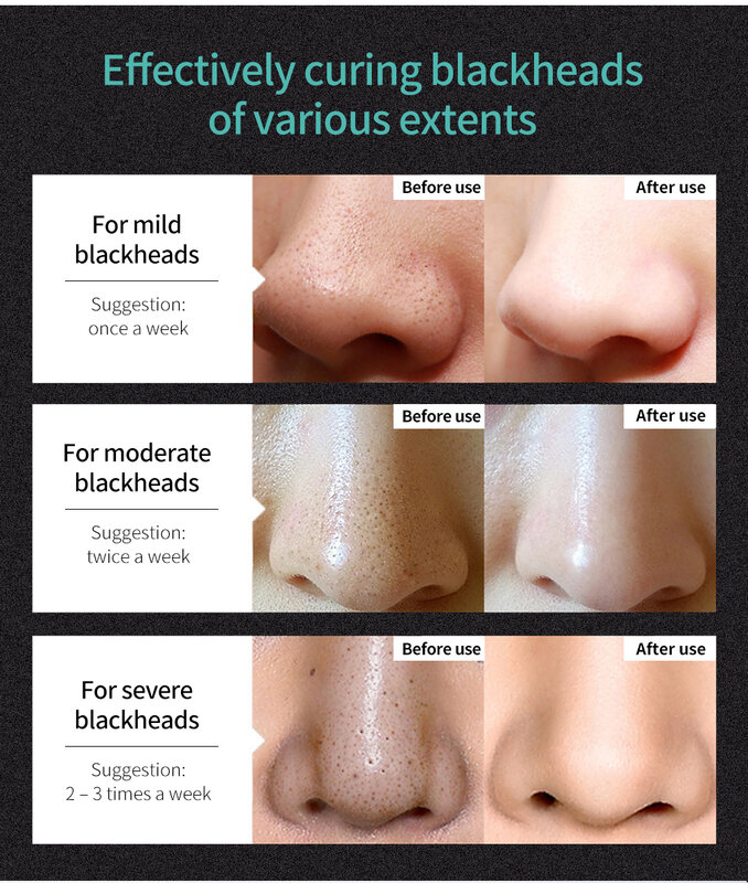 LANBENA rimozione di punti neri maschera nera trattamento dell'acne per il viso Peeling staccabile pori termoretraibili pulizia del carbone maschera per il naso cura della pelle