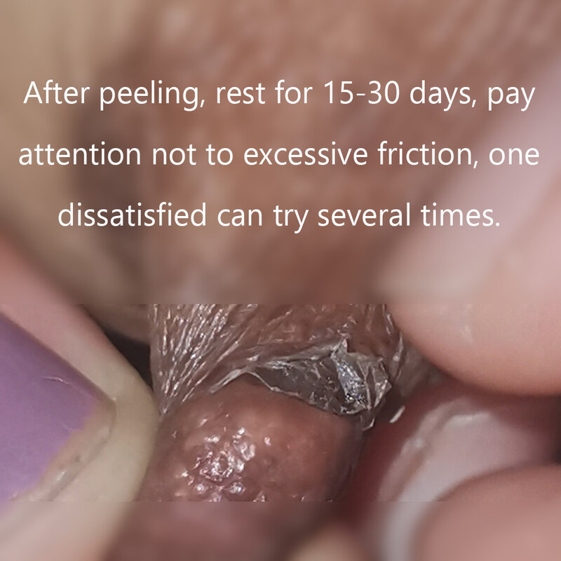 Klitoris Schamlippen Peeling Säure Reines Brustdrüsen Warzenhof Frau Klitoris Stimulator Leistungsstarke Sucker Klitoris Reines Erfrischend