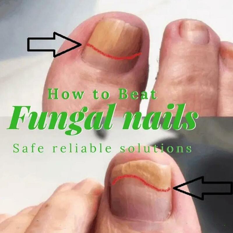 Tratamiento de uñas con hongos, suero antibacteriano, reparación áspera, descolorida, antiinfección, paroniquia, onicomicosis, cuidado de los pies