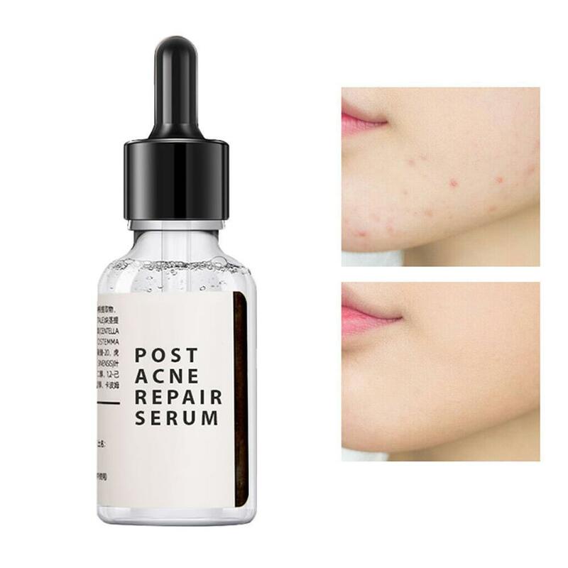 30ml Salicylic Acid 2% Solution Removes Acne Face Serum Shrinks Pore Moisturizing Essence Fade Spot Brighten Face Skin Care