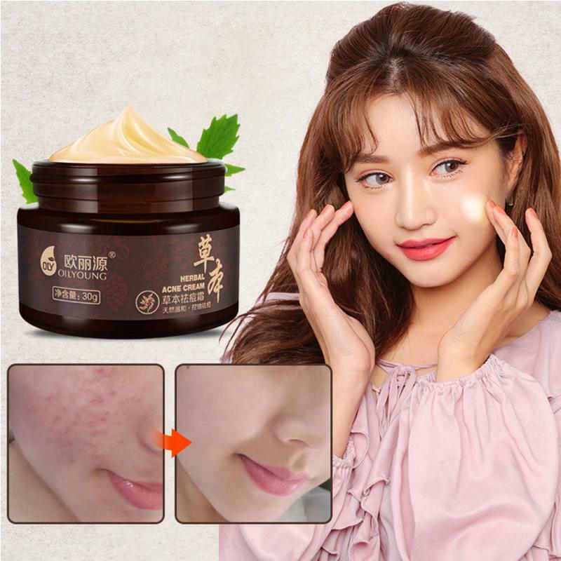 2021 Remove black head anti acne oil control cream Organic herbaceous substances Beauty Moisturizing treatment acne Repair Cream