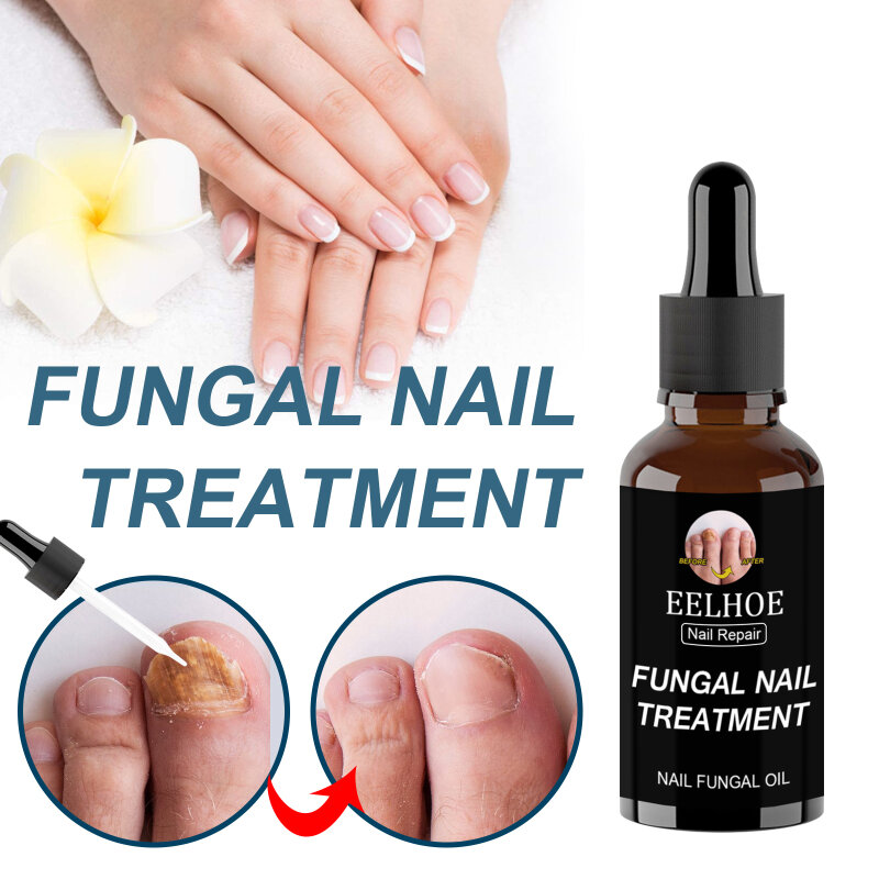 Cuidado eelazada-Tratamiento de hongos para uñas, reparación líquida, tratamiento de uñas, antihongos, crema reparadora de dedos de los pies