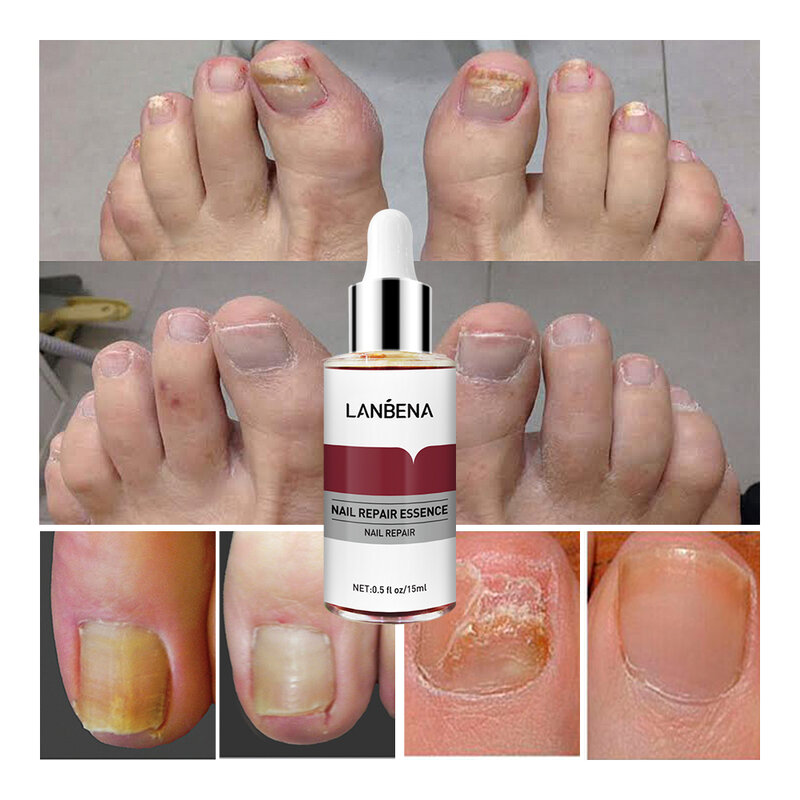 Сыворотка LANBENA грибок ногтей, восстанавливающая эссенция для ногтей на пальцах ног, уход восстановление онихомикоз, смягчение, осветление р...